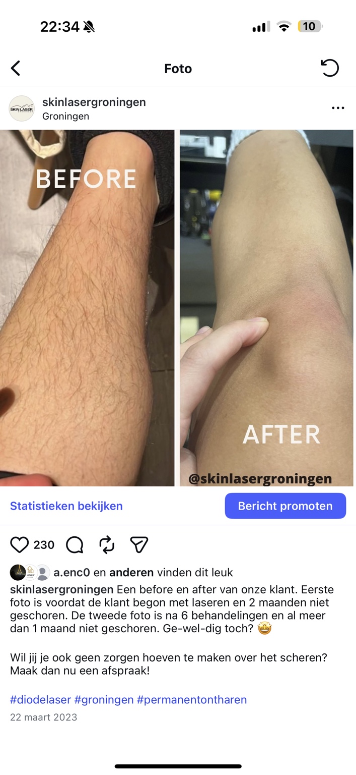 Voor en na laserontharing been