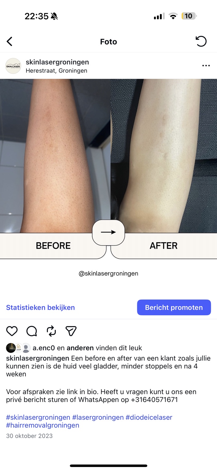 Voor en na laserontharing onderbeen